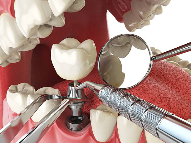 Best Dental Abscess Treatment in Eldora, IA